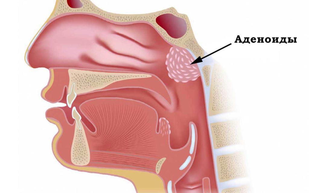 аденоиды